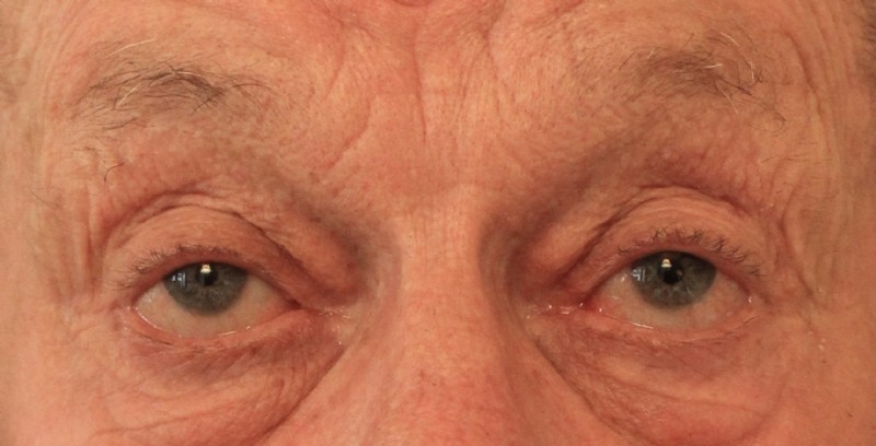 Het wijd open sperren van de oogleden is bij een ptosis vaak niet goed mogelijk.