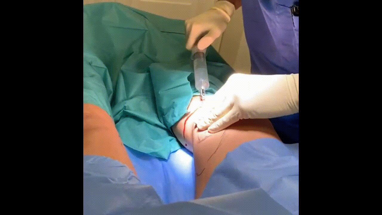 Plastisch chirurg Michel Cromheecke voert een liposuctie aan de knieën uit. Een kleine liposuctie als deze is geschikt om uit te voeren onder plaatselijke verdoving.