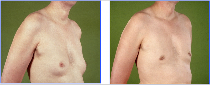 Voor & na: Gynaecomastie behandeling met liposuctie. Operatie uitgevoerd door plastisch chirurg Michel Cromheecke.