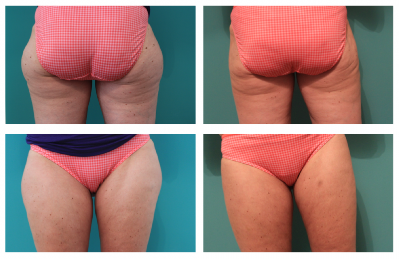 Liposuctie buitenzijde bovenbenen. Rechts het resultaat na 2 maanden. Operatie door plastisch chirurg Michel Cromheecke