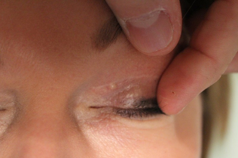 Een atheroomcyste in het litteken van een bovenooglidcorrectie is goed te verwijderen.