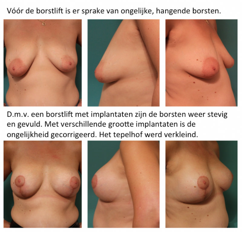 Borstlift door Michel Cromheecke: foto's voor en zes weken na de operatie