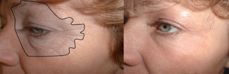 Fenol peeling bij rimpels rondom de ogen. Resultaat na 3 jaar