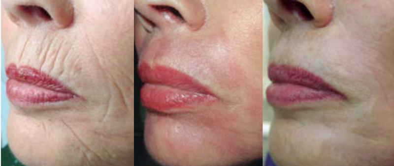 Resultaat Lip & Eyelid mozaiek peeling bij rokerslijntjes na 10 dagen en 3 jaar