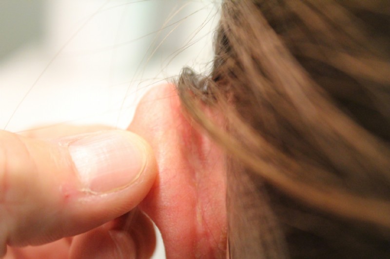  Door de operatie komt er een litteken achter het oor.