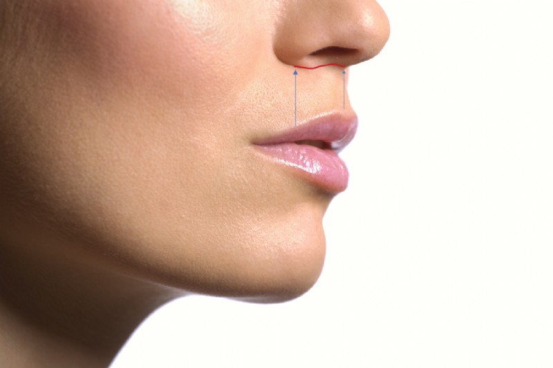 Voor een liplift moet er voldoende ruimte zijn tussen de neus en bovenlip. Het littekentje (rode lijntje) wordt geplaatst vlak onder de neus en zal uiteindelijk niet tot nauwelijks meer zichtbaar zijn.