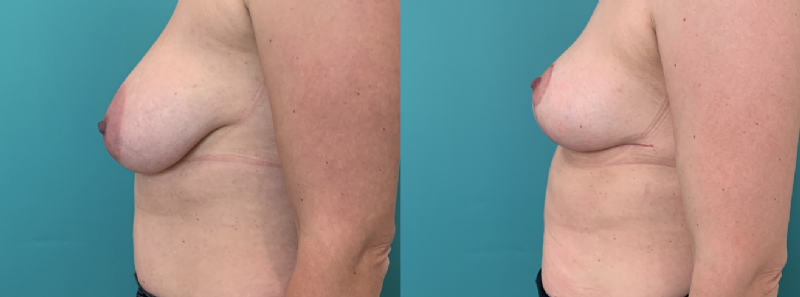 Borstverkleining door plastisch chirurg Michel Cromheecke. Voor de operatie (links) en 8 weken na de operatie (rechts)