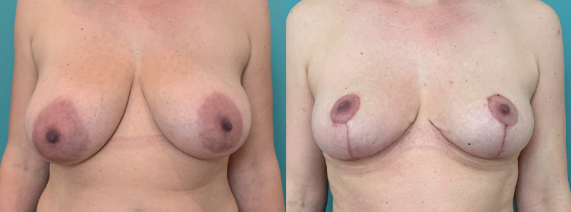 Borstverkleining door plastisch chirurg Michel Cromheecke. Voor de operatie (links) en 8 weken na de operatie (rechts)