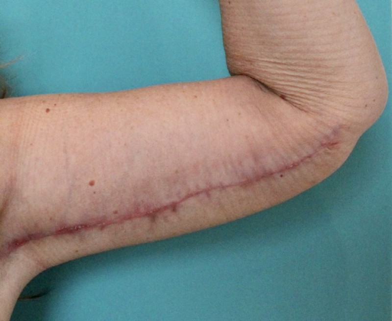 Armlift door plastisch chirurg Michel Cromheecke, 3 weken na de operatie.