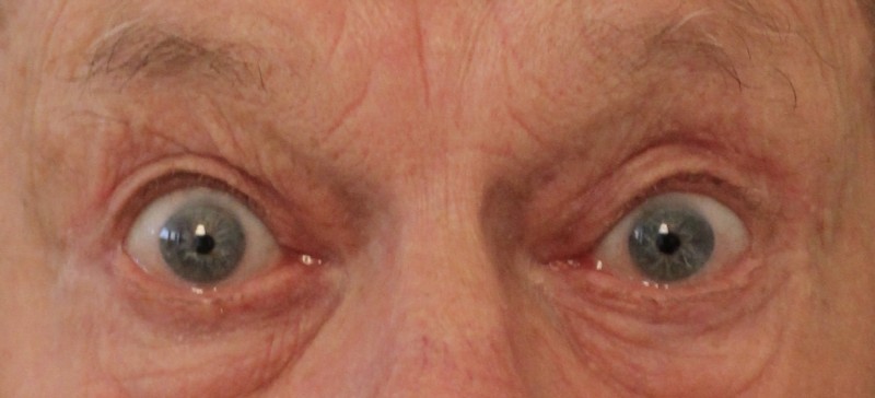 Na de ptosiscorrectie is de patiënt in staat de ogen wagenwijd open te sperren. Operatie door plastisch chirurg Michel Cromheecke