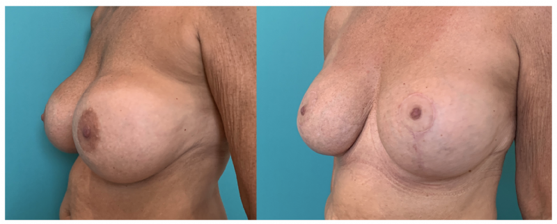 Borstlift met vervangen implantaten voor Motiva implantaten - Voor (links) en 4 maanden na (rechts) de operatie door plastisch chirurg Michel Cromheecke