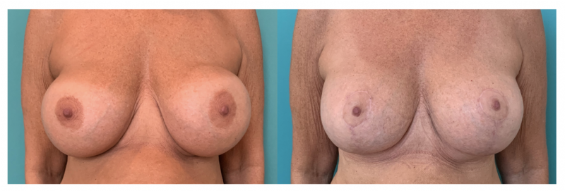 Borstlift met vervangen implantaten voor Motiva implantaten - Voor (links) en 4 maanden na (rechts) de operatie door plastisch chirurg Michel Cromheecke